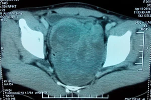 Mổ bóc khối u lớn trước xương cùng cụt hiếm gặp