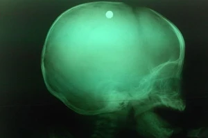 Nghịch súng tự chế, chị gái bắn vào đầu em trai