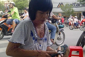 Người giữ xe nghèo bị tạt acid