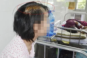 Bé 15 tuổi bị “cha dượng” chém nứt sọ 