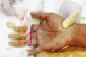 Bị máy ép mùn cưa cắt đứt ba ngón tay