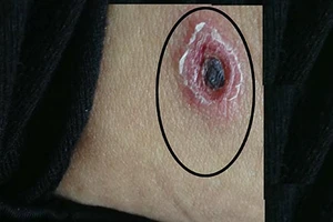 Bệnh sốt mò: Tỉ lệ tử vong 50%-60%