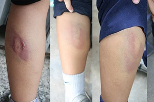 Cô giáo đánh bốn học sinh bầm tím chân