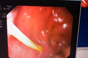 Nội soi lấy tăm đâm vào thành bụng