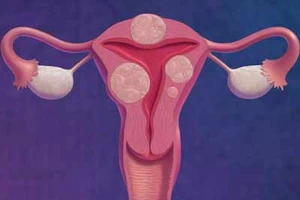 Điều trị u xơ tử cung không cần phẫu thuật