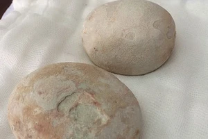 Lấy hai viên sỏi to bằng trứng vịt ra khỏi bàng quang