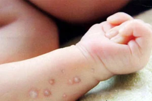 Bệnh thủy đậu vào mùa sớm