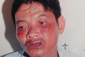 Nhập viện sau khi đến công an xã ‘làm việc’?