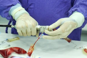 Lần đầu tiên ghép tế bào gốc máu dây rốn cho bệnh nhân tan máu