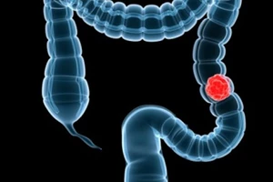 Hy vọng mới chữa ung thư ruột kết