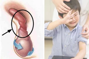 Cảnh giác cao độ với xoắn tinh hoàn 