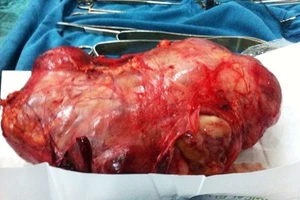 Cắt khối u thận ‘khủng’ 2,9 kg