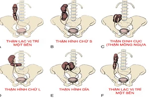 Một quả thận vẫn học tập và làm việc tốt