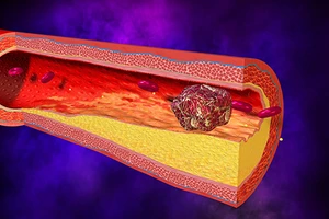 Nhận lời cầu hôn ngay sau khi được ‘gắp’ cục máu đông 