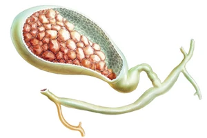 Túi này có sỏi, túi kia hết tiền!