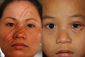 Hai mẹ con bị hàng xóm rạch nát mặt