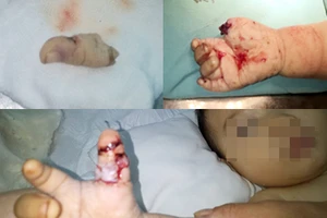 Siêu vi phẫu cứu ngón tay bé 10 tháng tuổi bị đứt lìa