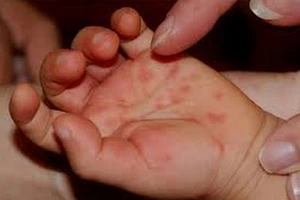 Bệnh tay-chân-miệng đang bùng phát tại Hà Nội và TP.HCM