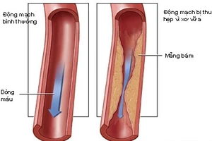 Mối nguy về calcium trong động mạch vành 
