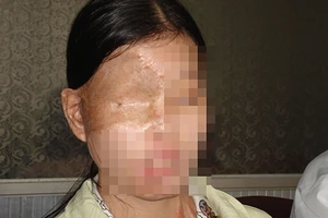 Bỏng do acid đâu phải dấu chấm hết