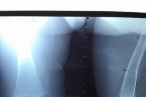 Phẫu thuật lấy kim khâu 1,5 cm khỏi khớp gối bé một tuổi