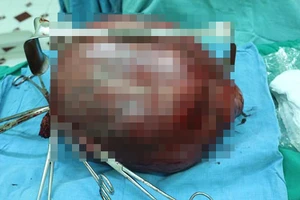 Cắt khối u xơ tử cung khổng lồ nặng 7,8 kg