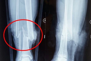 Nối thành công chi đứt lìa nhờ sơ cứu ban đầu tốt