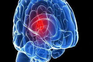 Học cao tăng nguy cơ u não