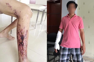 Bỏng tay, hoại tử chân vì chất thông cống 