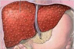 Gần 30.000 ca tử vong do viêm gan virus/năm