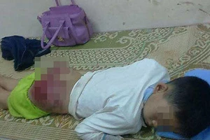 Cha đánh con trai 13 tuổi nhập viện cấp cứu