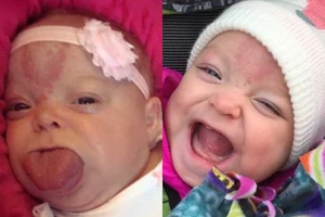 Cô bé lưỡi to đã có nụ cười đầu tiên