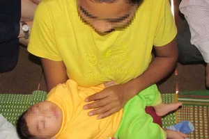 Xác định ca teo não đầu tiên do virus Zika 