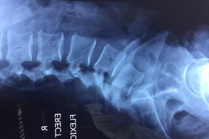 Nắn trượt cột sống cho bệnh nhân bằng robot