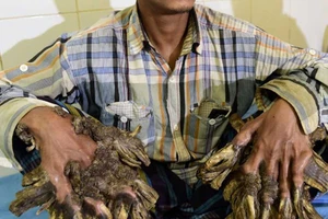 ‘Người cây’ đã trở lại bình thường