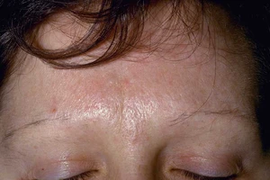 Lông mày rụng cũng thành chuyện lớn 