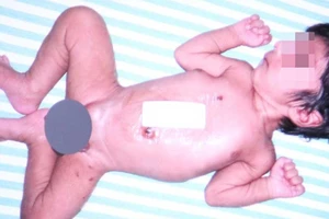 Bé trai Ấn Độ có 4 chân, 2 dương vật