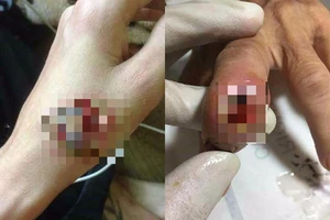 Làm đẹp bằng laser, con dao 2 lưỡi 