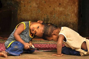 Tách thành công cặp song sinh dính chung hộp sọ