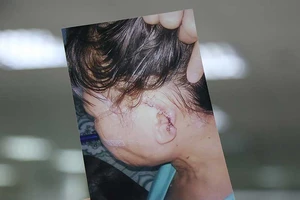 Cắn người đứt tai, thoát tội nhờ quy định mới