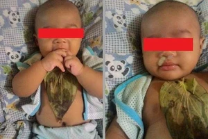 Gây hại con trẻ vì tin vào bài thuốc dân gian