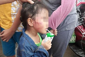 Bình Chánh: Cô giáo đánh trẻ nứt xương hàm