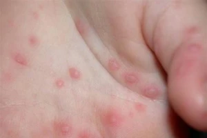 Miền Trung phát hiện thêm nhiều ổ dịch tay-chân-miệng