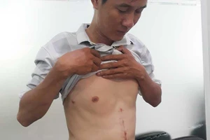 Bị thương tích nặng khi ngăn người khác đánh nhau