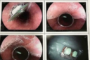 Suýt nguy kịch vì uống thuốc còn nguyên vỏ