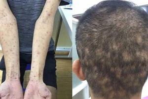 Báo động bệnh giang mai tăng cao, trẻ hóa