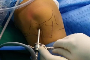 Chơi bóng rổ té, tự uống thuốc giảm đau, phải phẫu thuật