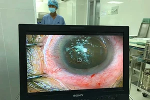 Nguy cơ mù mắt vì tia laser điều trị thẩm mỹ da