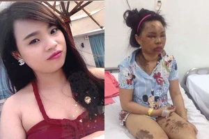 Nỗi đau của cả gia đình bị tạt acid