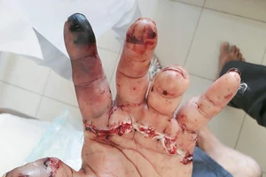 Khánh Hòa: Nối thành công bàn tay bị đứt lìa